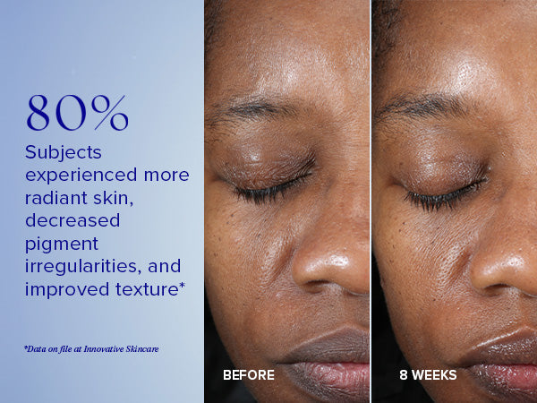 Active Peel System