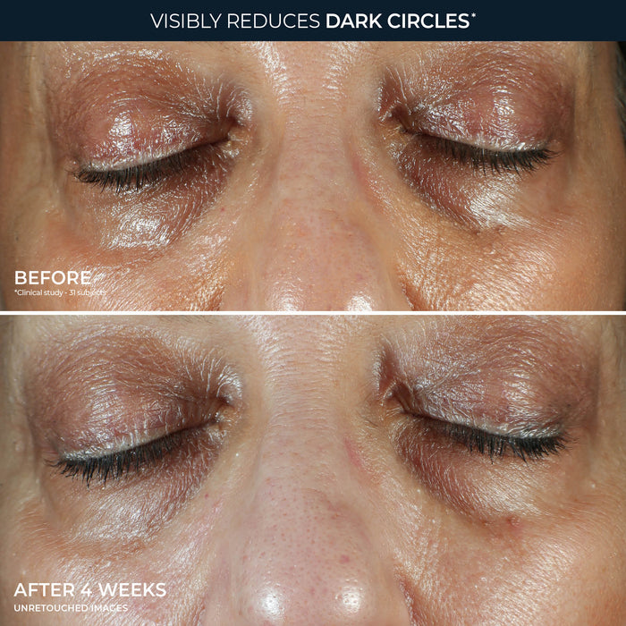 MULTI CORREXION® Even Tone + Lift Eye Cream Before and after image of participant's eye area showing a visible reduction in under eye darkness.