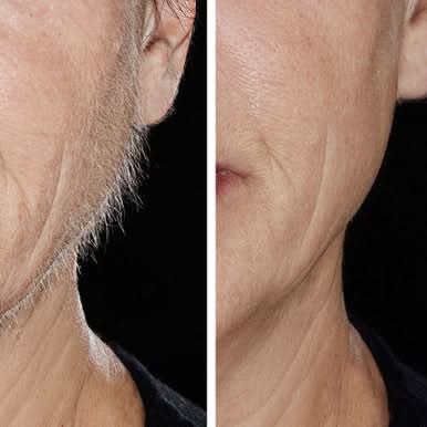 Hollywood Smoother, Replacement Heads- Rose Gold