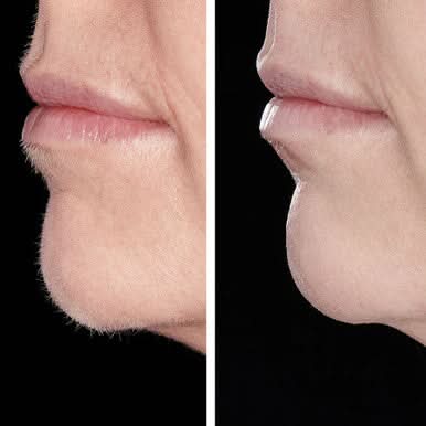 Hollywood Smoother, Sonic Dermaplaner- Rose Gold