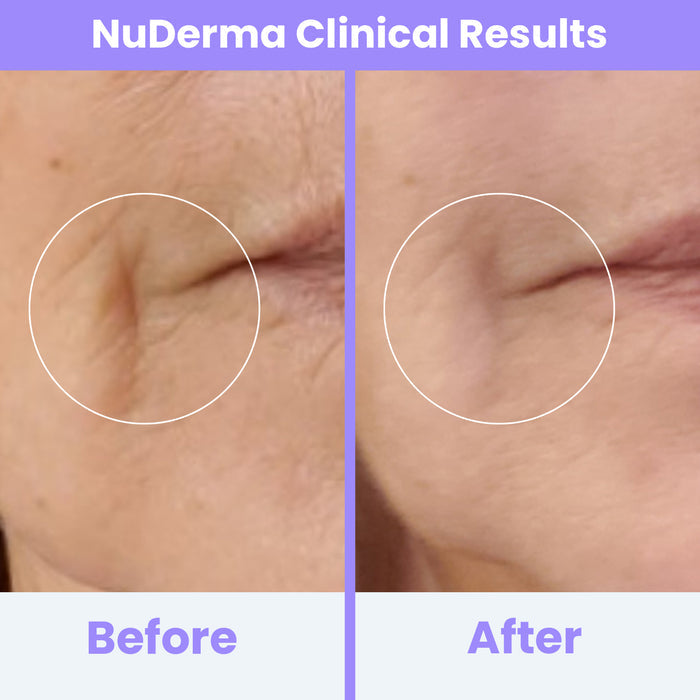 NuDerma Clinical before and after results