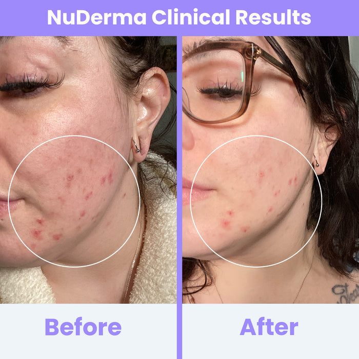 NuDerma Clinical before and after results