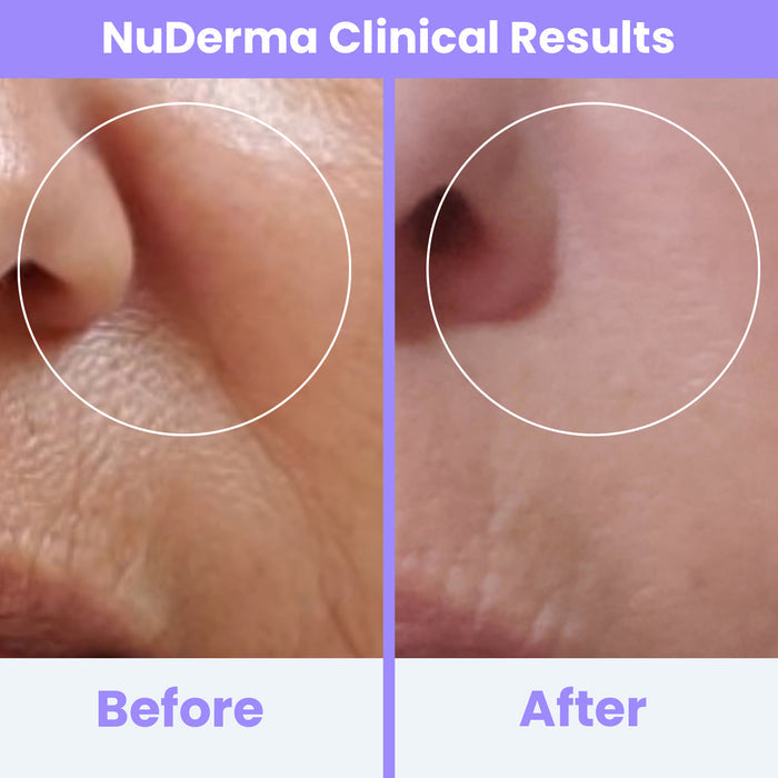 NuDerma Clinical before and after results