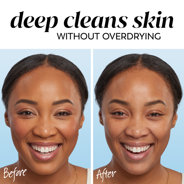 2 images model showing before and after. Deep cleans skin without over drying.