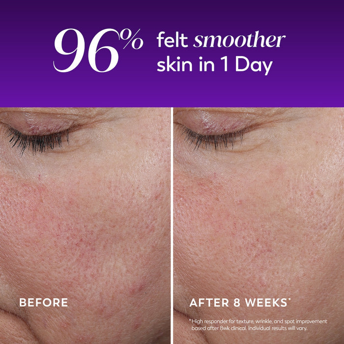 Images of Before and after 8 weeks applying Regenerist Wrinkle Correcting Night Treatment 96% felt smoother skin in 1 day.