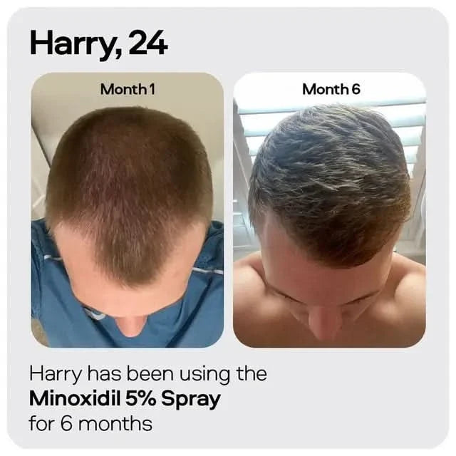 Sons Minoxidil 5% Spray 3 Pack x2