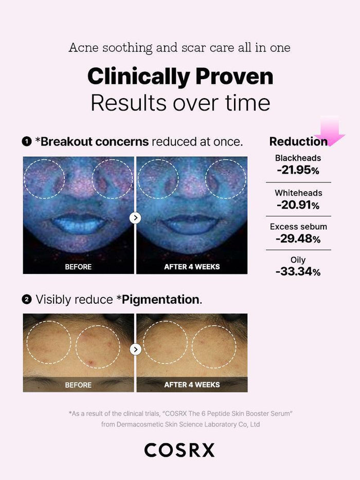 Clinical before-and-after images showing reduction in blackheads, whiteheads, and pigmentation after 4 weeks of COSRX The 6 Peptide Skin Booster Serum use; peptide and NAG formula improving sebum balance, clarity, and even tone.