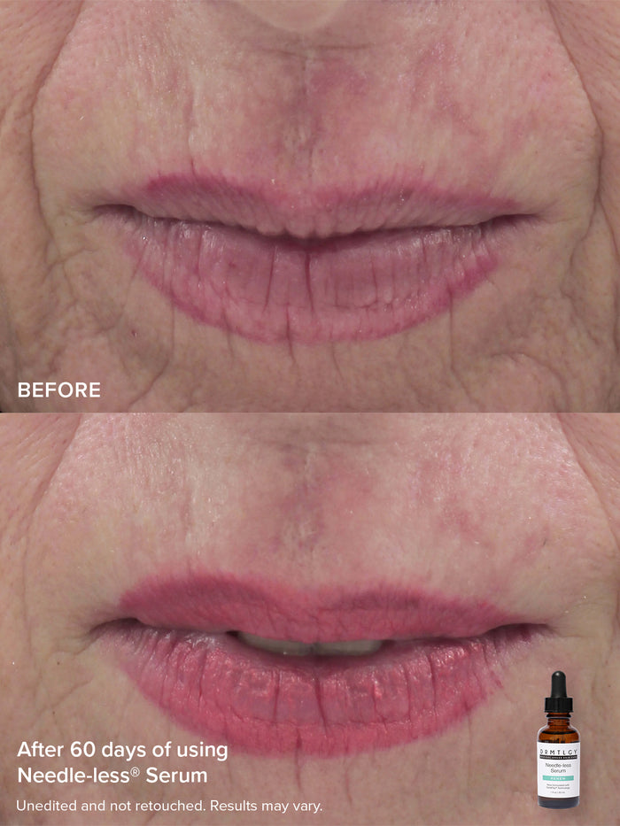 The Needle-less® Duo