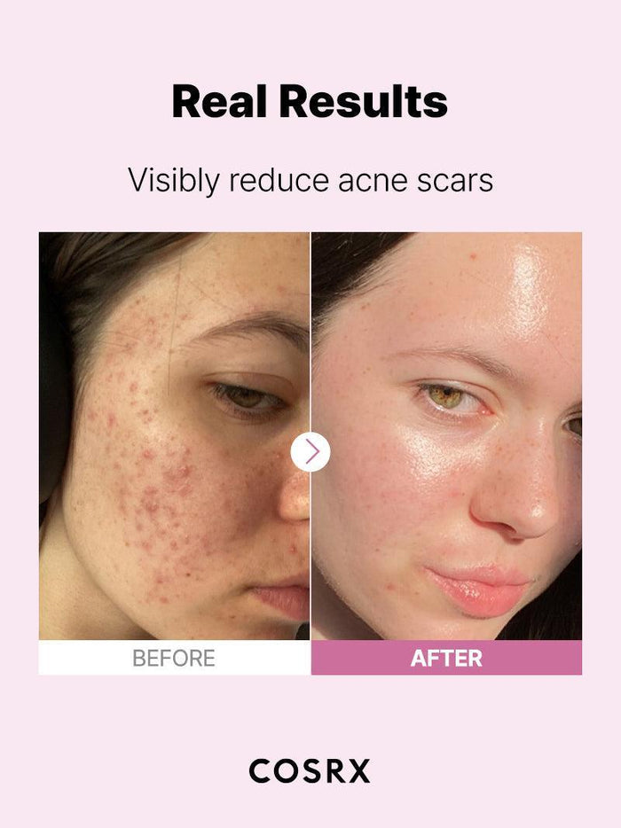 Before-and-after user results showing visible reduction of acne scars and smoother skin after consistent use of COSRX The Niacinamide 15 Serum; formulated to minimize sebum and refine large pores while fading dark spots.